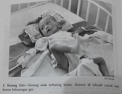Penderita Gizi Buruk (sumber: buku Seandainya Aku Bukan Anakmu)